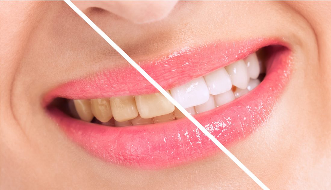 Forniture dentali | Dental Club